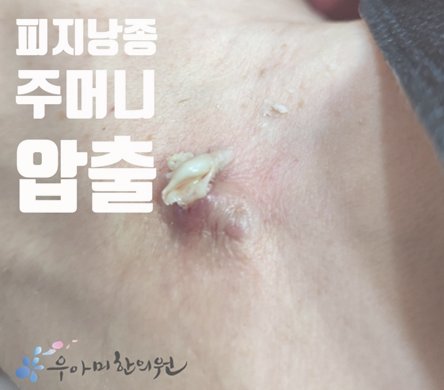 얼굴 피지낭종 제거｜작은 구멍 아래 숨어 있는 주머니