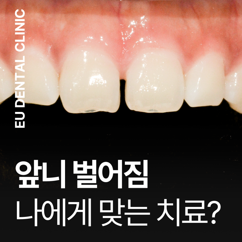 부산이샘병원 앞니 벌어짐 레진부터 교정까지, 나에게 맞는 방법은?