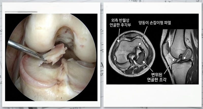 [수원/팔달 손해사정] 무릎 반월상 연골판 파열(M23.2/S83.2) 관절경 수술 후, 뼈 안 부러졌어도 ....