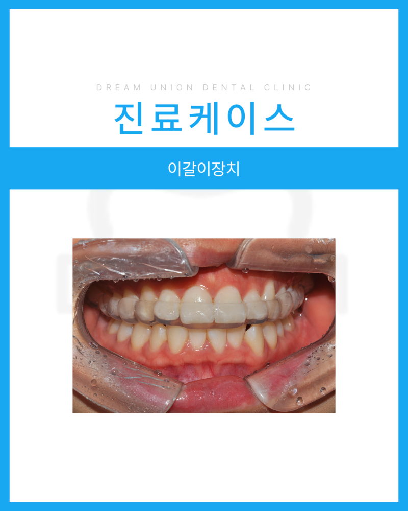 삼산동치과｜이갈이 장치, 어떤 경우에 필요할까요?