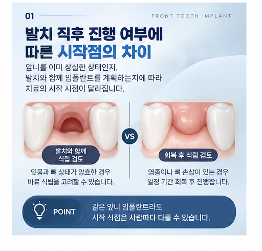 앞니임플란트기간 체크할 부분들