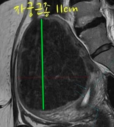 "자궁근종 복강경 수술 리얼 후기" 산부인과 간호사와 10cm 자궁근종 수술 환자와의 인터뷰!