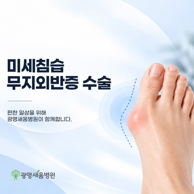 미세침습 무지외반증 수술 어떤 경우에 필요할까요?