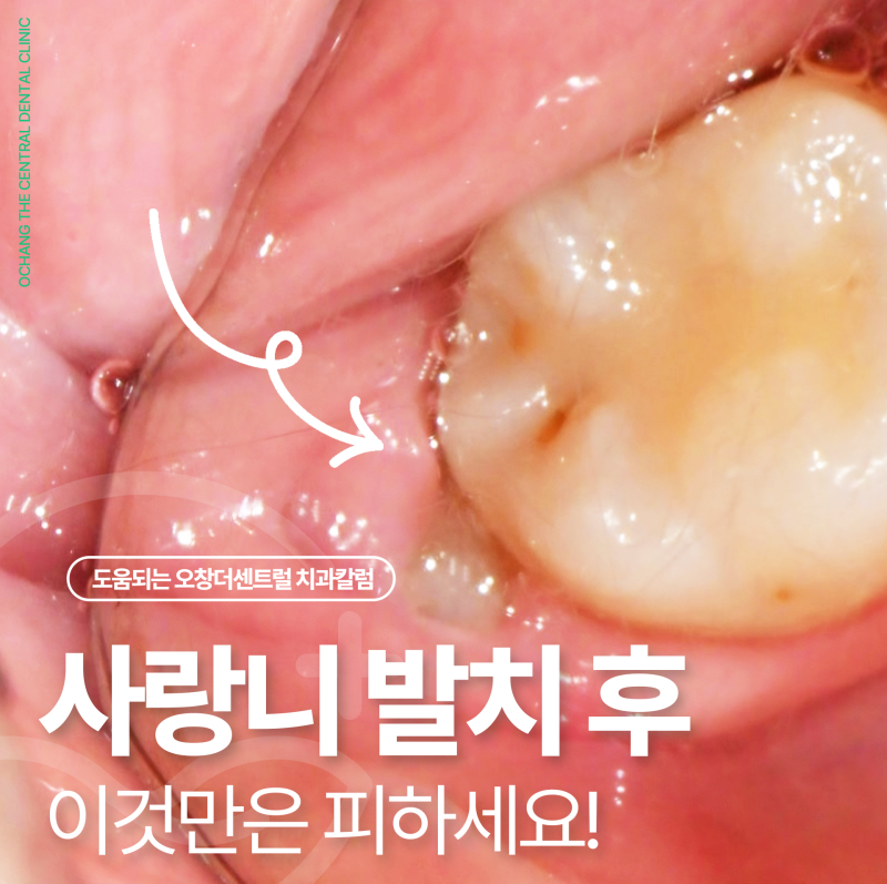 사랑니 발치 후 통증 줄이기 위한 숨겨진 방법이 있을까요?