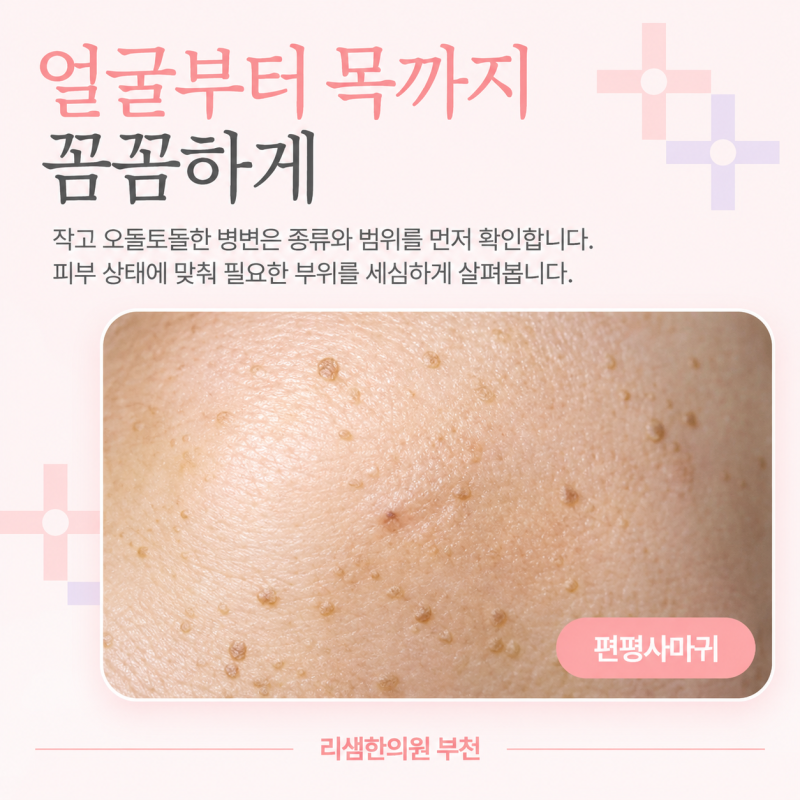 부천 상동역 편평사마귀 성지에서 무제한 제거하세요