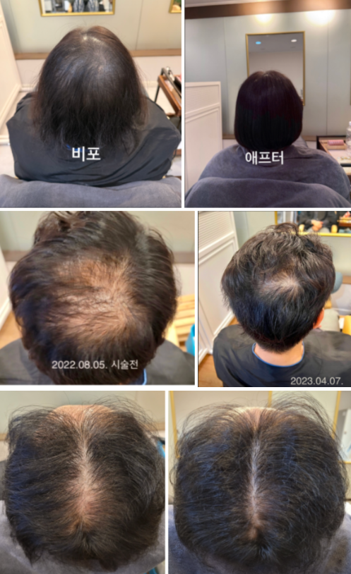고양시탈모병원 약 끊으면 그때뿐? 먼저 확인할 2가지 (20년 차 두피관리)