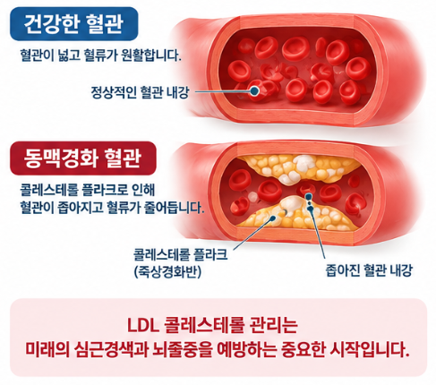LDL 콜레스테롤이 뭐길래? 건강검진에서 높게 나왔다면 수치부터 확인하세요