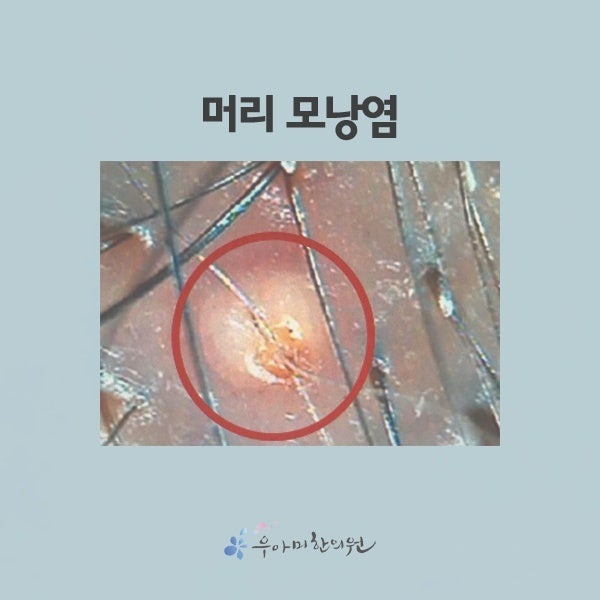 두피 모낭염 압출, 고름이 보인다고 모두 짜는 것은 아닙니다