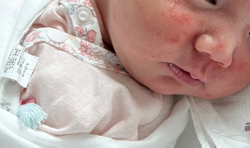 신생아 태열, 얼굴 오돌토돌할 때 직접 확인해본 관리법