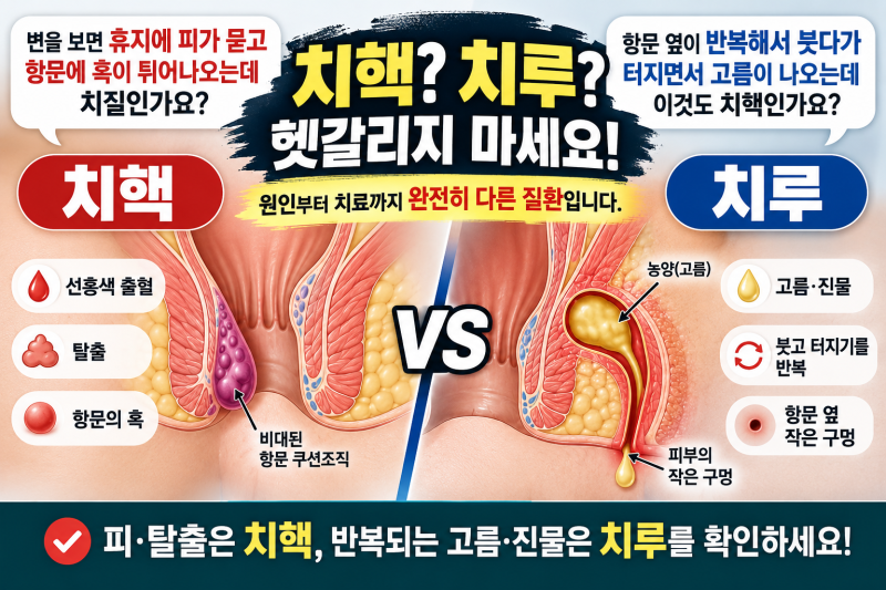 치핵·치루 차이 총정리 | 항문에 혹·피·고름이 나올 때 증상 & 자연치유·수술해야 하는 경....