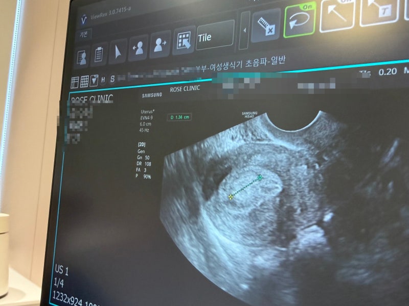 제주 자궁경부 용종 수술, 오나정산부인과 자궁경 폴립 제거 및 보험 청구 방법