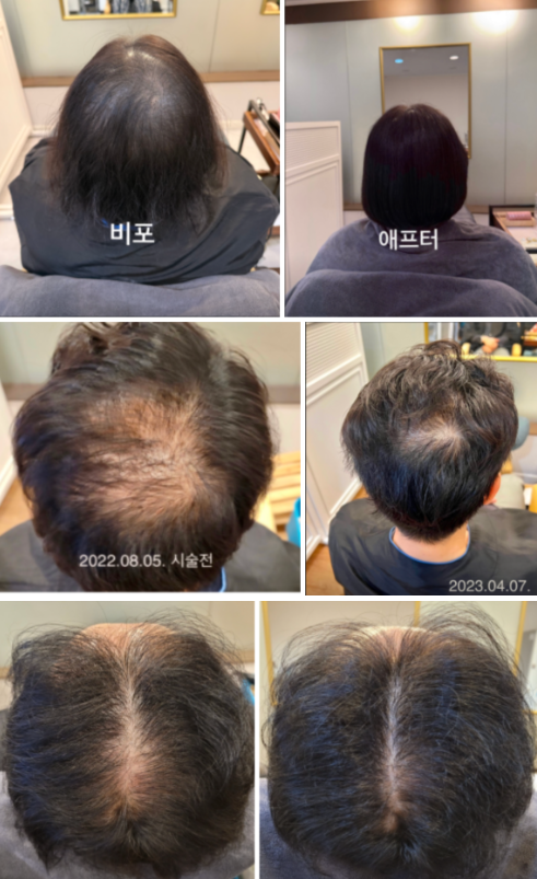 일산 탈모관리 받기 전 반드시 알아야 할 2가지 <20년 차 두피관리 원장 조언