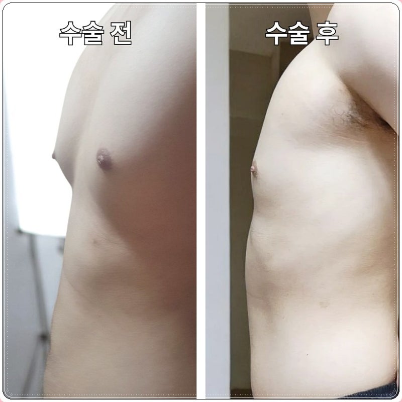 남자여유증수술비용 등급 확인 전과 후 상담 방식 비교 [Dr.디에이 여유증]