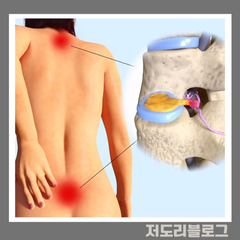 허리디스크가 심하게 파열되면 왜 대소변 조절도 잘 안되는 걸까요?