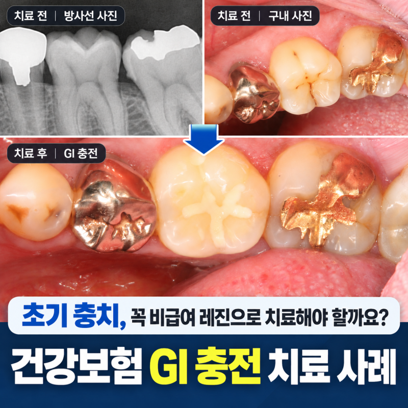 초기 충치, 꼭 비급여 레진으로 치료해야 할까요?｜건강보험 GI 충전 치료 사례