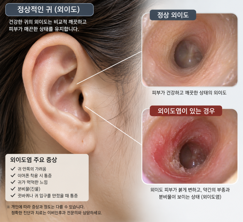 하루 종일 이어폰 끼는 사람 주의｜귀가 가렵다면 외이도염 신호일 수도 있습니다