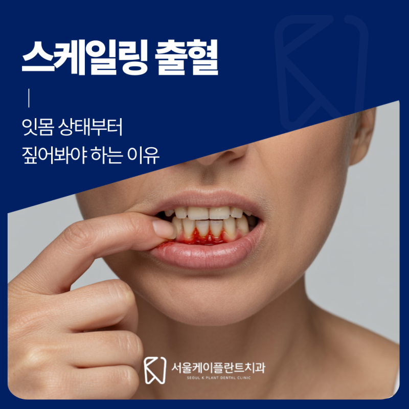작전동치과 스케일링을 받을 때마다 유독 피가 많이 난다면 잇몸 상태부터 짚어봐야 하는 이....