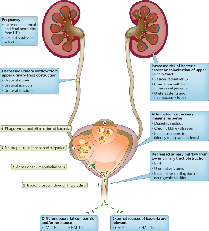 요로감염 UTI (Urinary Tract Infection) 신우신염 Pyelonephritis: 의료진 병원 진료·연구 디렉토리 2026