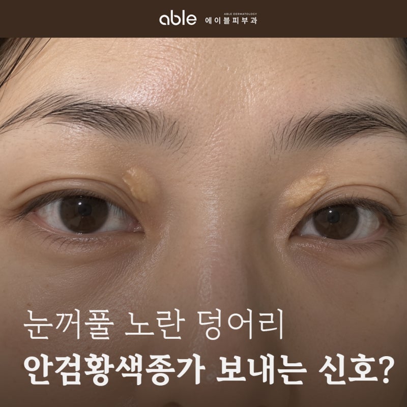 복정역 피부과 안검황색종, 눈꺼풀 노란 덩어리가 보내는 신호?