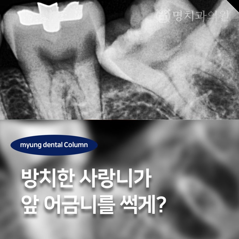방치한 사랑니가 앞 어금니를 썩게 할 수 있을까요?