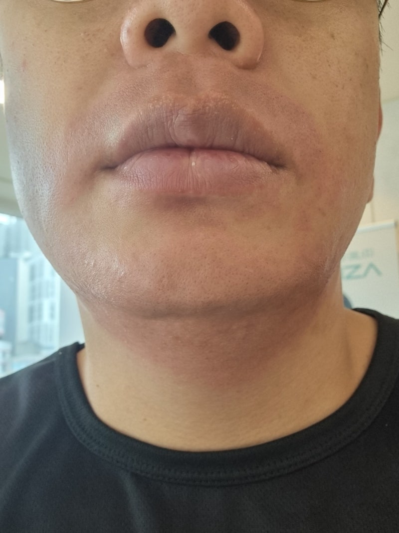 레이저 제모 7회차 내 돈 내산 솔직 후기, 효과는 대만족인데 재방문 안 하는 이유