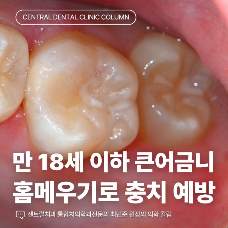어린이 충치 예방 실란트는 건강보험 적용될까요?