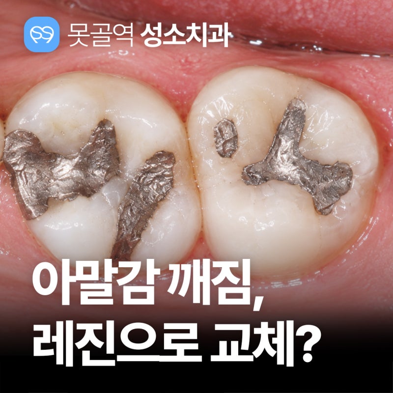 아말감 깨짐 떨어졌을 때, 레진으로 교체 필요?