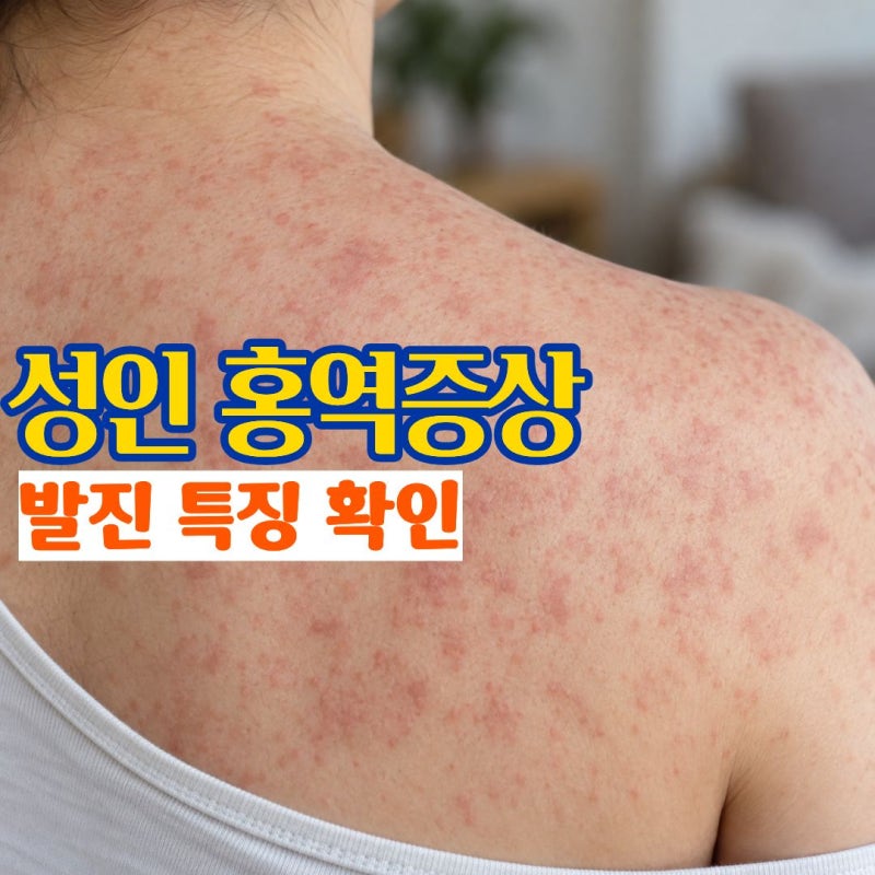 홍역증상 성인에게 나타나는 홍역 수두 차이와 홍역예방접종 준비
