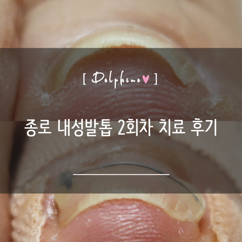 여자 엄지발톱무좀 갈라짐 깨짐 통증 종로 문제성발톱 내성발톱 치료 교정 2회차 내돈내산 ....