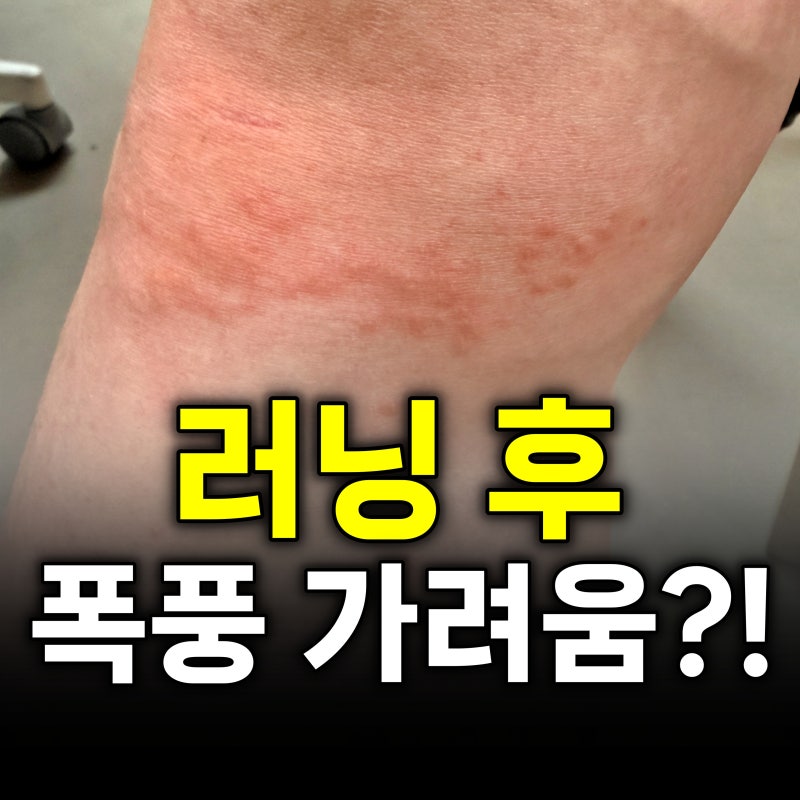러닝 10분 만에 온몸이 찌릿 운동만 하면 터지는 콜린성 두드러기 대처법