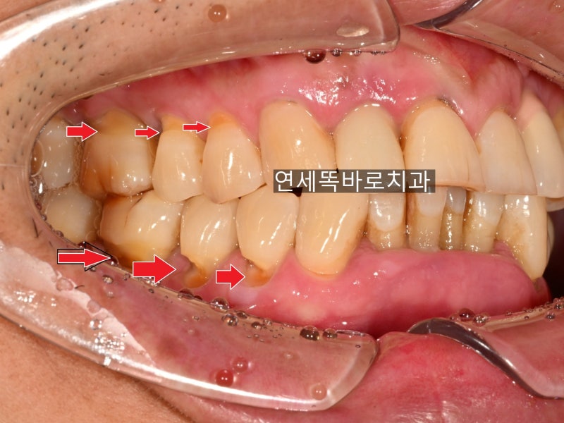 치아 목 부분이 패였다면? NCCL(치경부 마모증), GI와 레진 차이부터 탈락 원인까지 파주운정치....