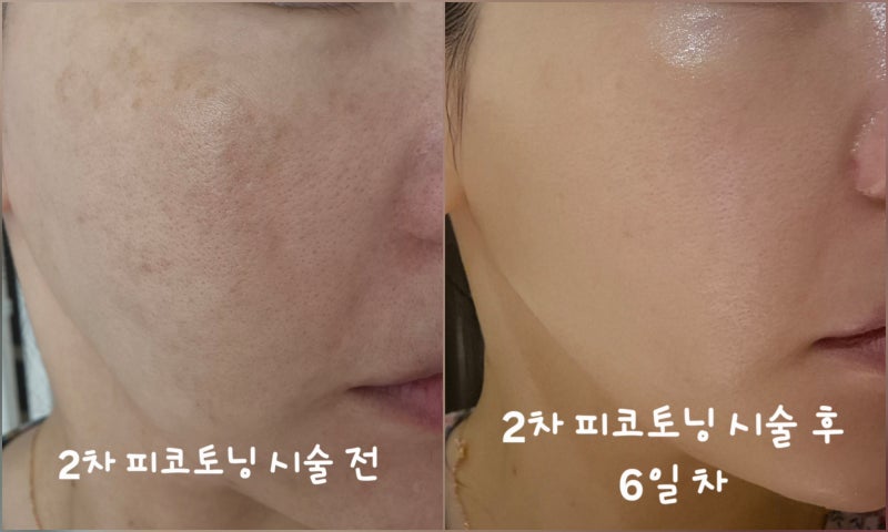 (내돈내산) 피코토닝 2회차 후기｜시술 전부터 6일차까지 잡티 변화 기록