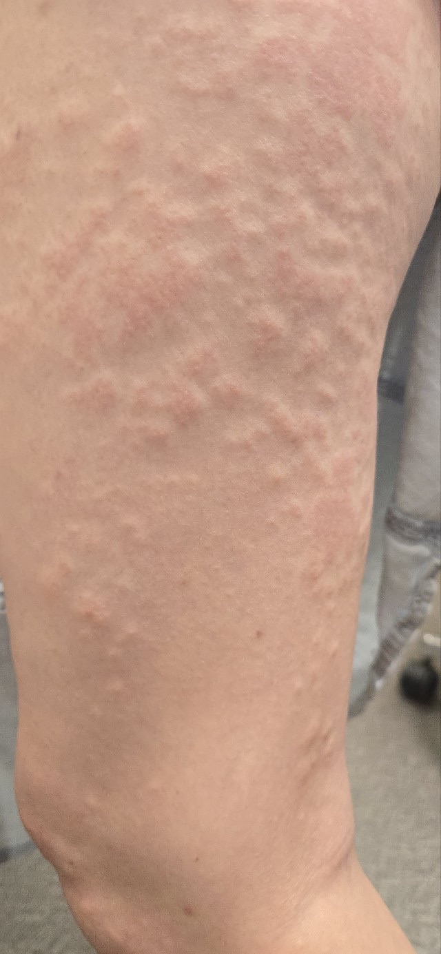 부산콜린성두드러기, 병원 가서 안낫는다고 얘기 들은 분만 보세요