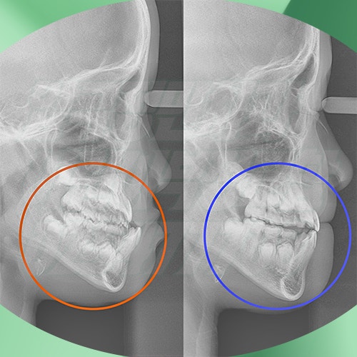 어린이 부정교합 교정기, 우리 아이에게 맞는 장치는?