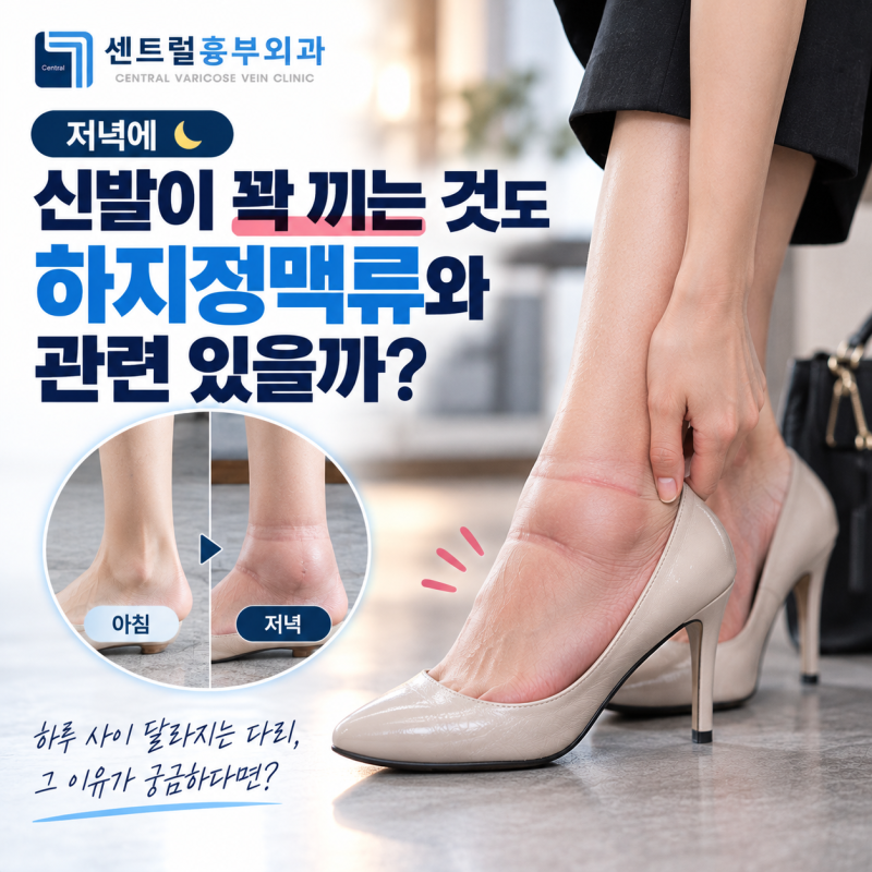 저녁에 신발이 꽉 끼는 것도 하지정맥류와 관련 있을까?