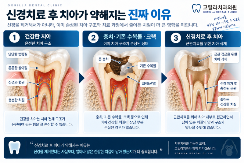 용인 치과, 신경치료 후 크라운은 꼭 해야 하나요? 안 씌우면 어떻게 될까요?