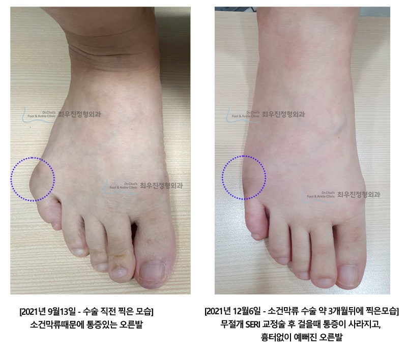 새끼발가락옆굳은살 빨갛게 부풀고 아프다면