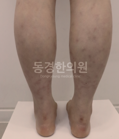 자가면역질환, 다리가 울긋불긋하다면? 청피반성 혈관염 가능성 있습니다