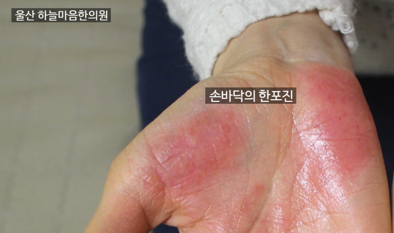 울산 한포진 치료, 손에 생긴 물집 모두 한포진일까요?