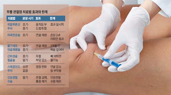 무릎 인공관절 수명 15년 20년 재수술 시기 관리법