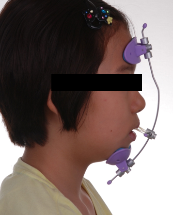 어린이 주걱턱 교정, 언제 시작해야 할까요? 성장기 치료 시기