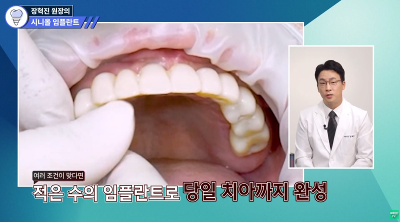 어금니임플란트 임시치아, 당일 장착이 가능한 경우와 주의사항