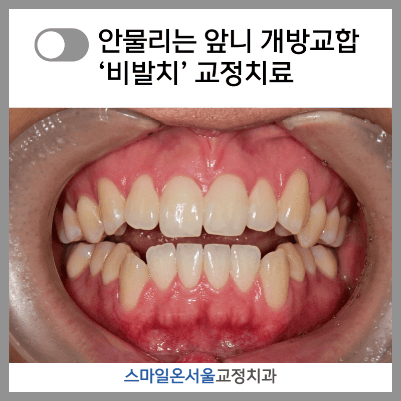 개방교합 교정 과정, 기간, 방법, 후기 - 건대 치과 비발치 교정치료