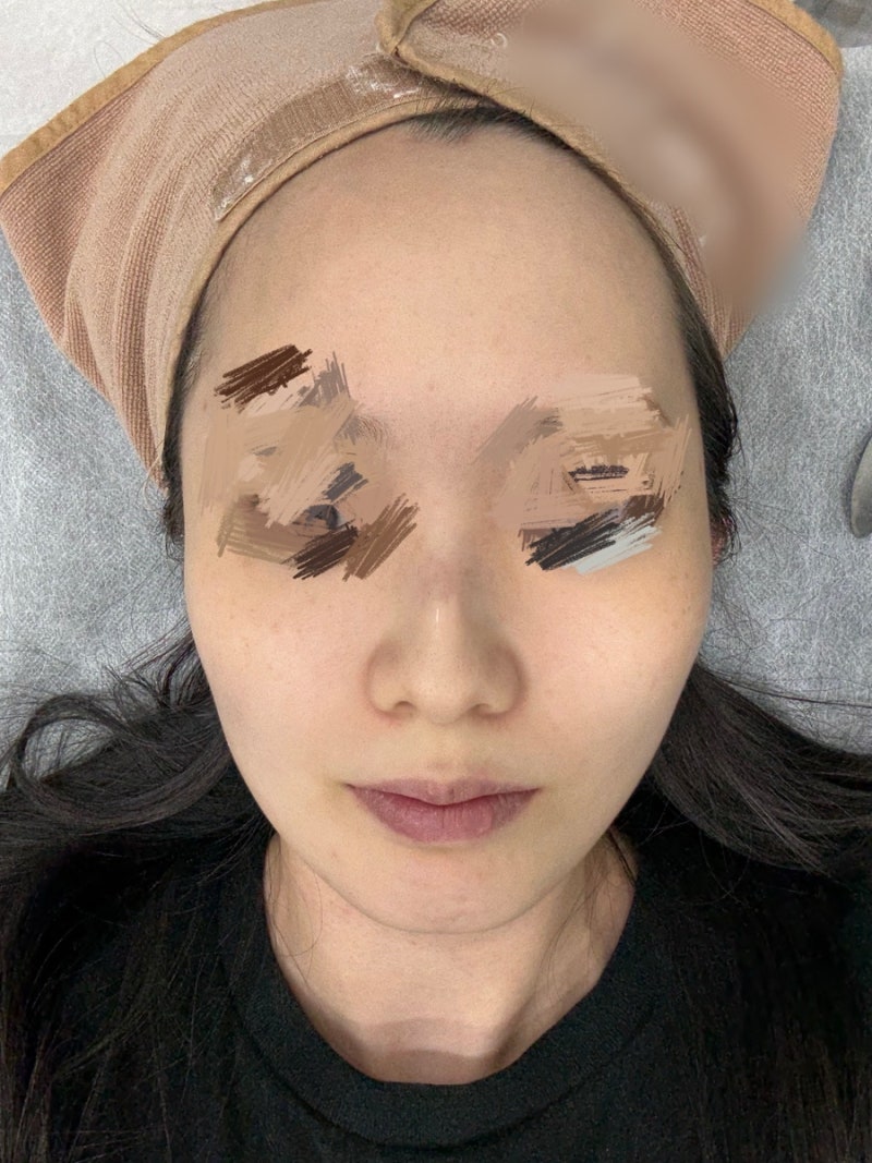 기미, 주근깨 잡티 색소침착레이저 내돈내산 피코슈어토닝 피코슈어줌패스 후기