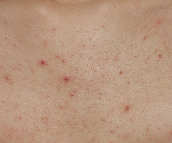 인천가슴여드름 가렵고 오돌토돌하다면? 모낭염과 구분해야 하는 이유, 가드름 치료까지