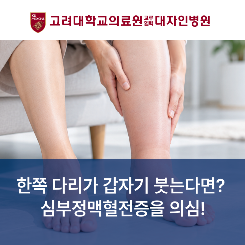 한쪽 다리가 갑자기 붓는다면? 심부정맥혈전증을 의심해야 하는 이유
