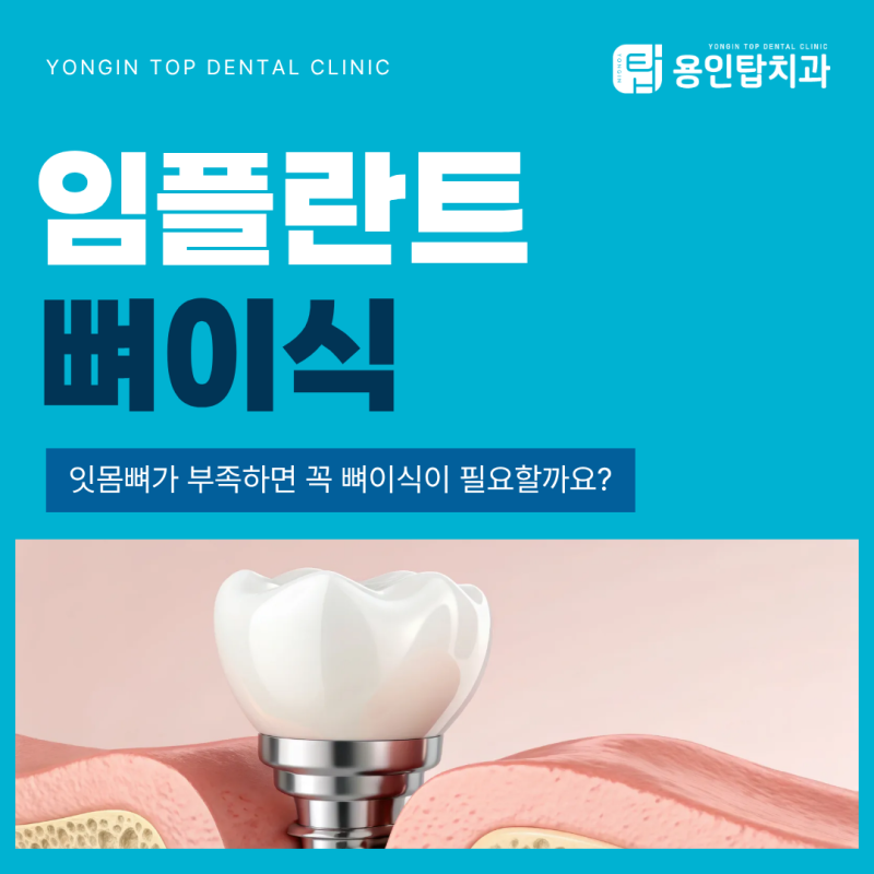 역북동임플란트, 잇몸뼈가 부족하면 꼭 뼈이식이 필요할까요?