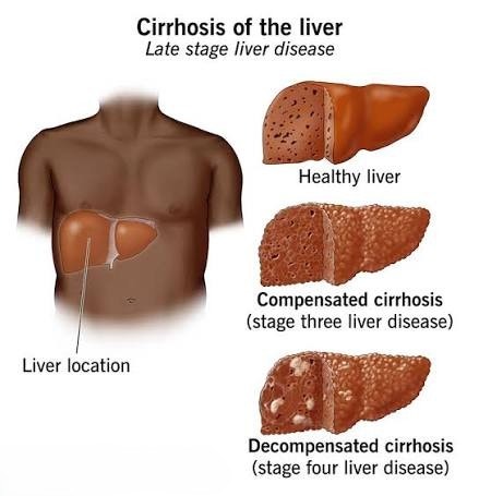 간경변증 Liver cirrhosis 증상·원인·치료 총정리