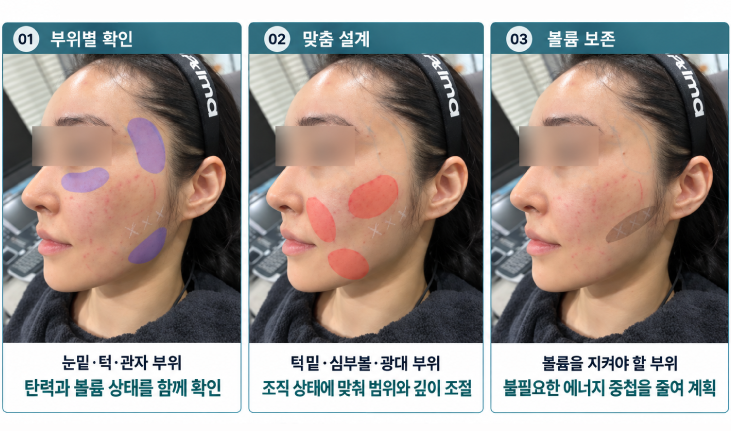 대전 울쎄라 600샷이면 내 얼굴에도 효과 있을까? 먼저 확인할 2가지