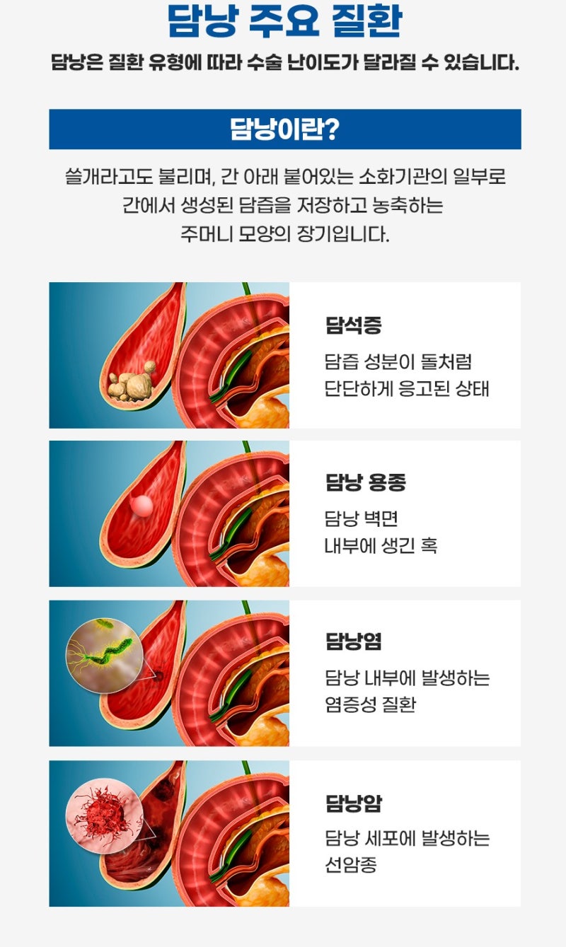 1cm 미만 vs 1cm 이상, 담낭용종 크기에 따라 달라지는 추적관찰과 수술 기준